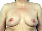 Breast Reduction - Case #3 After