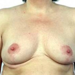 Breast Reduction - Case #3 After