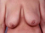 Breast Reduction - Case #4 Before
