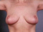 Breast Reduction - Case #4 After