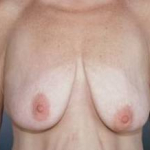 Breast Reduction - Case #5 Before