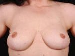 Breast Reduction - Case #6 After
