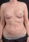 Liposuction - Case #14 Before