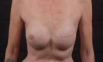 Delayed Breast Reconstruction - Case #8 After