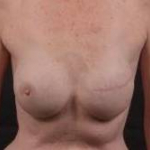 Delayed Breast Reconstruction - Case #8 After