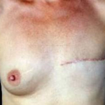 Delayed Breast Reconstruction - Case #1 Before