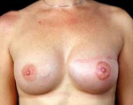 Delayed Breast Reconstruction - Case #1 After