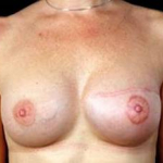 Delayed Breast Reconstruction - Case #1 After