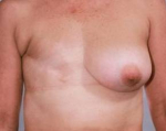 Delayed Breast Reconstruction - Case #3 Before