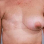 Delayed Breast Reconstruction - Case #3 Before