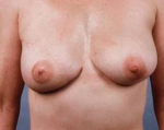Delayed Breast Reconstruction - Case #3 After