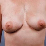Delayed Breast Reconstruction - Case #3 After