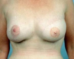 Delayed Breast Reconstruction - Case #4 After
