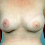 Delayed Breast Reconstruction - Case #4 After