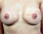 Delayed Breast Reconstruction - Case #5 After