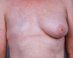 Delayed Breast Reconstruction - Case #6 Before