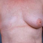 Delayed Breast Reconstruction - Case #6 Before