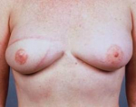 Delayed Breast Reconstruction - Case #6 After