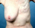 Delayed Breast Reconstruction - Case #7 Before