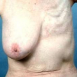 Delayed Breast Reconstruction - Case #7 Before