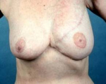 Delayed Breast Reconstruction - Case #7 After