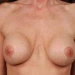 Immediate Breast Reconstruction - Flaps - Case #1 Before