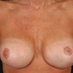 Immediate Breast Reconstruction - Flaps - Case #1 After