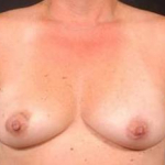 Immediate Breast Reconstruction - Flaps - Case #3 Before