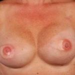 Immediate Breast Reconstruction - Flaps - Case #3 After