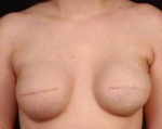 Immediate Breast Reconstruction - Flaps - Case #5 Before