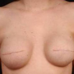 Immediate Breast Reconstruction - Flaps - Case #5 Before