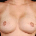 Immediate Breast Reconstruction - Flaps - Case #5 After