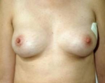 Immediate Breast Reconstruction - Flaps - Case #6 Before