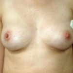 Immediate Breast Reconstruction - Flaps - Case #6 Before
