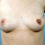 Immediate Breast Reconstruction - Flaps - Case #6 After