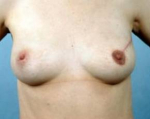 Immediate Breast Reconstruction - Flaps - Case #7 After
