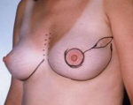 Immediate Breast Reconstruction - Flaps - Case #8 Before
