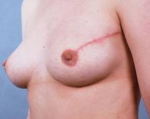 Immediate Breast Reconstruction - Flaps - Case #8 After