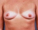 Immediate Breast Reconstruction - Flaps - Case #9 Before