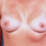 Immediate Breast Reconstruction - Flaps - Case #9 After
