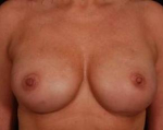 Prophylactic Mastectomy - Case #1 After