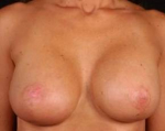 Prophylactic Mastectomy - Case #2 After
