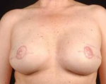 Prophylactic Mastectomy - Case #4 After