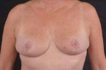 Breast Reduction - Case #7 After