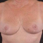Breast Reduction - Case #7 After