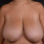 Breast Reduction - Case #8 Before