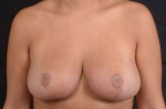 Breast Reduction - Case #8 After