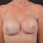 Immediate Breast Reconstruction - Nipple Sparring - Case #48 After