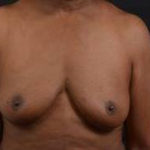 Immediate Breast Reconstruction -  Skin Sparring - Case #45 Before