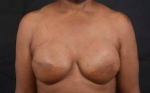 Immediate Breast Reconstruction -  Skin Sparring - Case #45 After